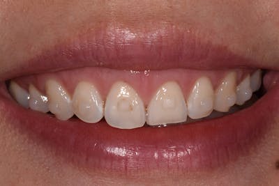 Patient Smile Before & After Gallery - Patient 421994 - Image 1