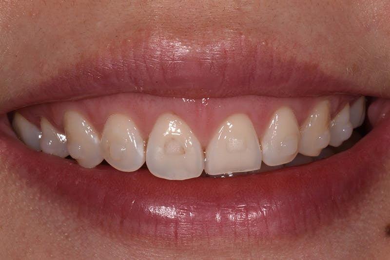 Patient Smile Before & After Gallery - Patient 421994 - Image 1