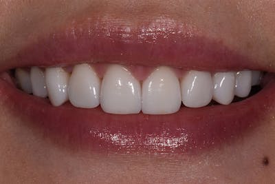 Patient Smile Before & After Gallery - Patient 421994 - Image 2