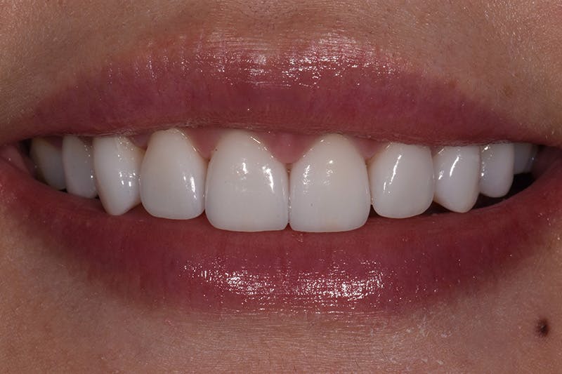 Patient Smile Before & After Gallery - Patient 421994 - Image 2