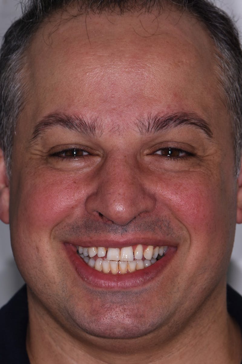 Patient Smile Before & After Gallery - Patient 977092 - Image 1