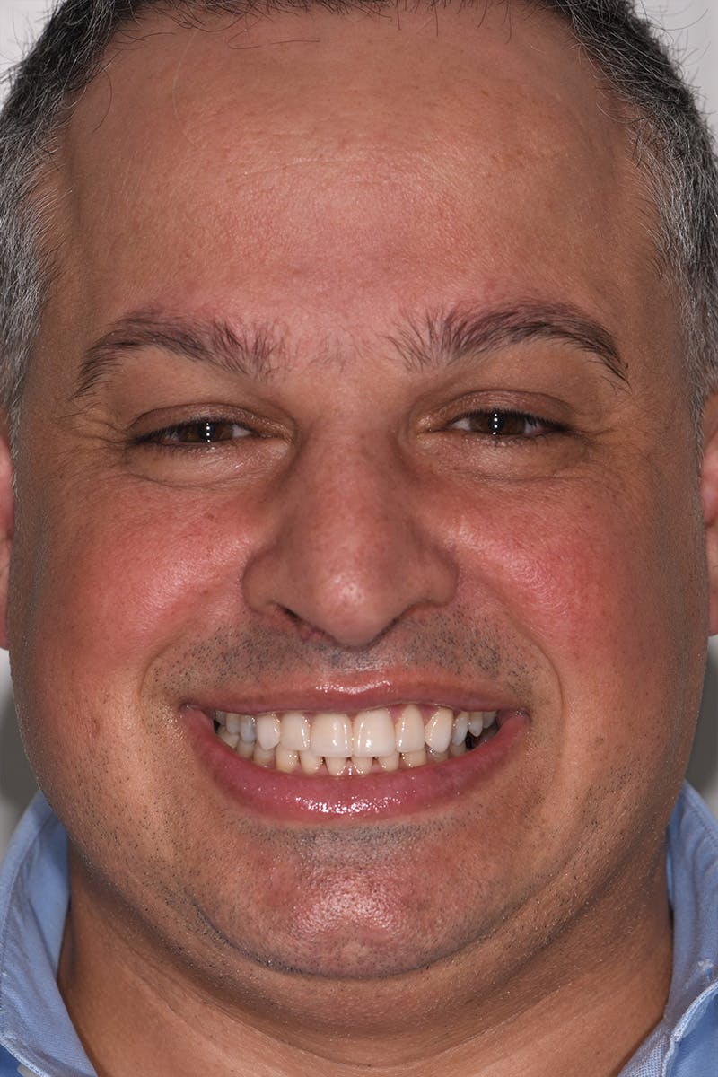 Patient Smile Before & After Gallery - Patient 977092 - Image 2