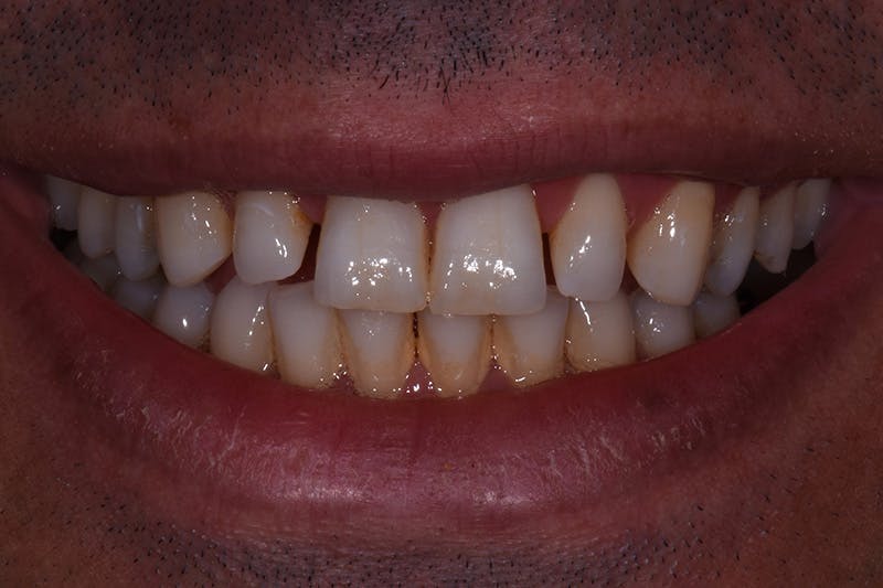 Patient Smile Before & After Gallery - Patient 977092 - Image 3