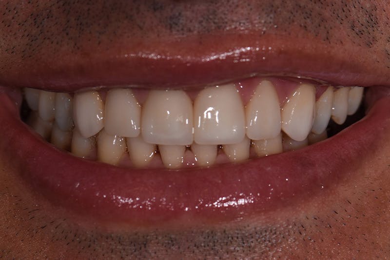 Patient Smile Before & After Gallery - Patient 977092 - Image 4