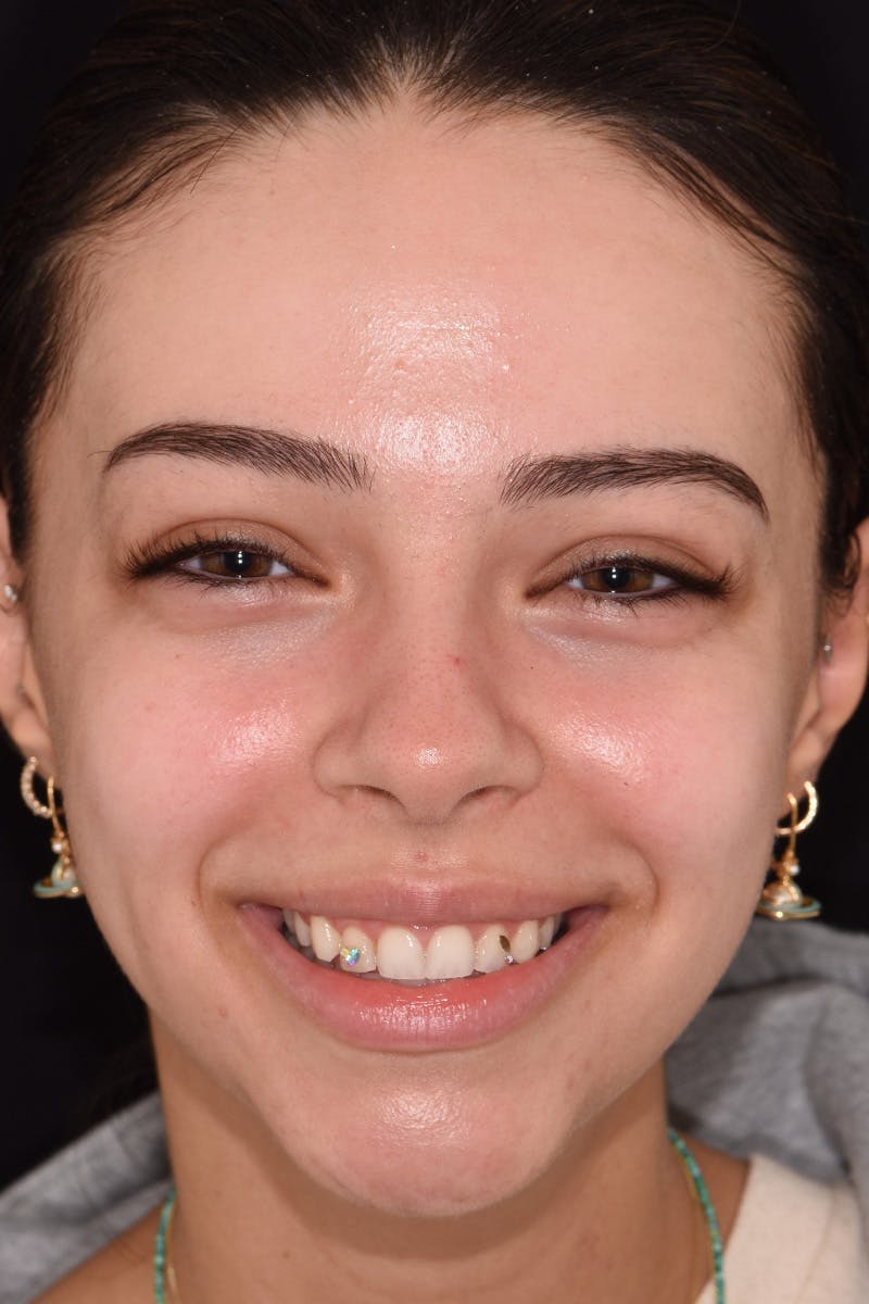 Patient Smile Before & After Gallery - Patient 783579 - Image 1