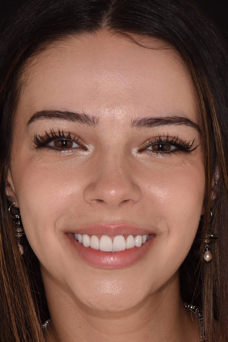 Patient Smile Before & After Gallery - Patient 783579 - Image 2