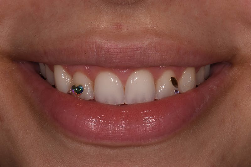 Patient Smile Before & After Gallery - Patient 783579 - Image 3