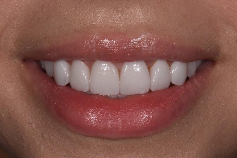Patient Smile Before & After Gallery - Patient 783579 - Image 4