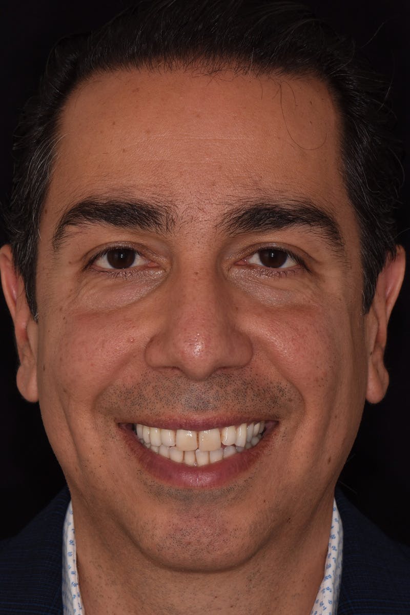 Patient Smile Before & After Gallery - Patient 360362 - Image 1