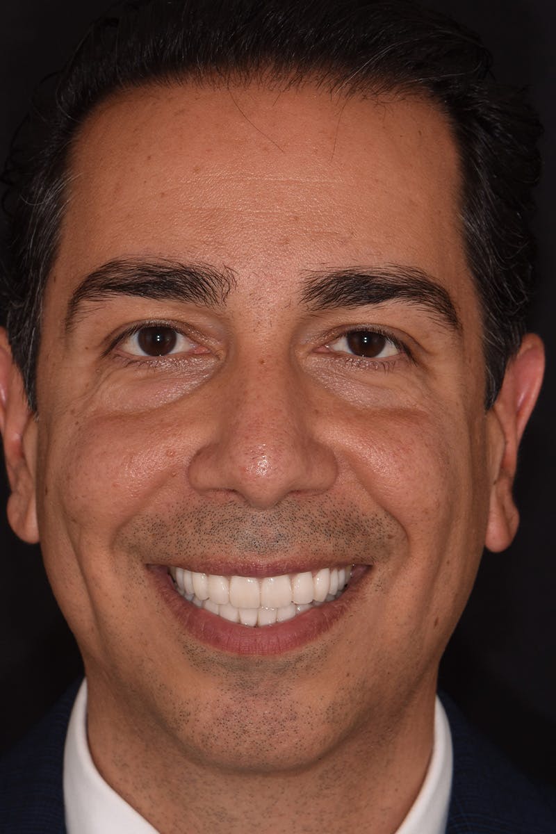 Patient Smile Before & After Gallery - Patient 360362 - Image 2