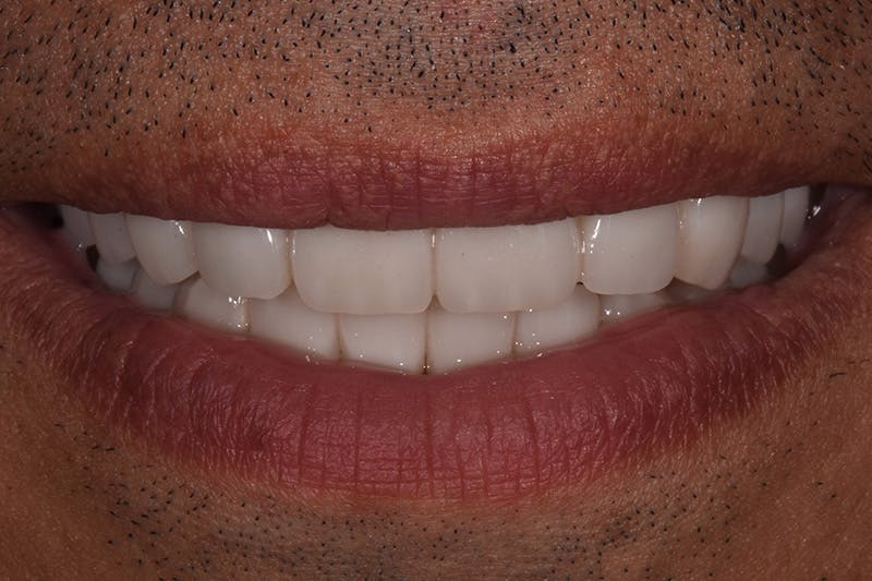 Patient Smile Before & After Gallery - Patient 360362 - Image 4