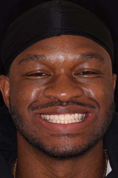 Patient Smile Before & After Gallery - Patient 306739 - Image 1