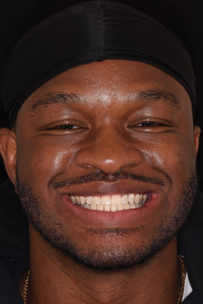 Patient Smile Before & After Gallery - Patient 306739 - Image 1