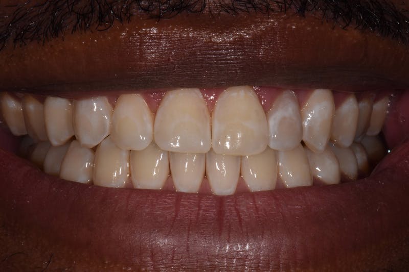 Patient Smile Before & After Gallery - Patient 306739 - Image 3