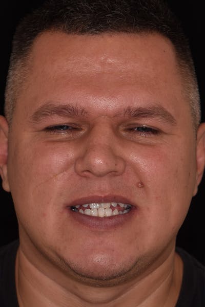 Patient Smile Before & After Gallery - Patient 248182 - Image 1