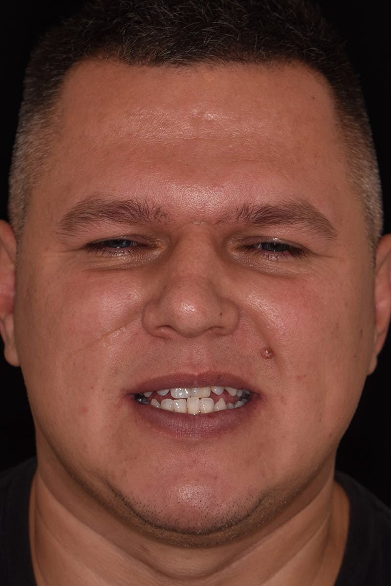 Patient Smile Before & After Gallery - Patient 248182 - Image 1