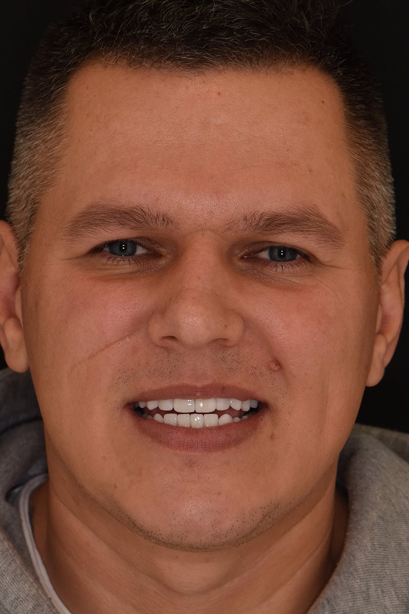 Patient Smile Before & After Gallery - Patient 248182 - Image 2