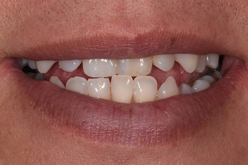 Patient Smile Before & After Gallery - Patient 248182 - Image 3