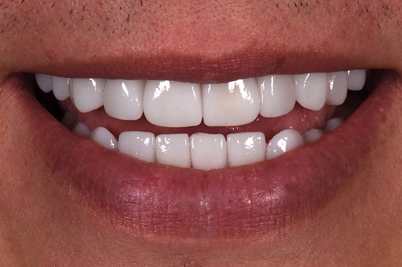 Patient Smile Before & After Gallery - Patient 248182 - Image 4
