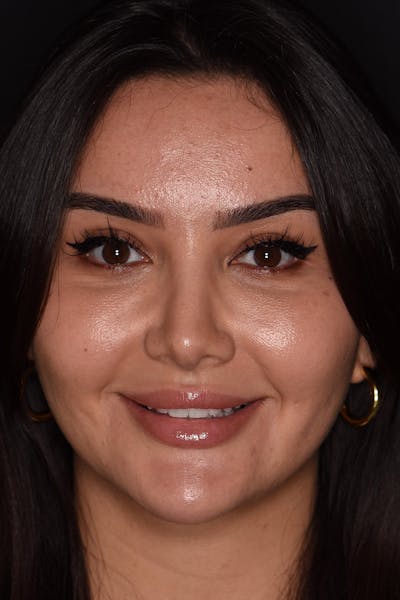 Patient Smile Before & After Gallery - Patient 117429 - Image 2