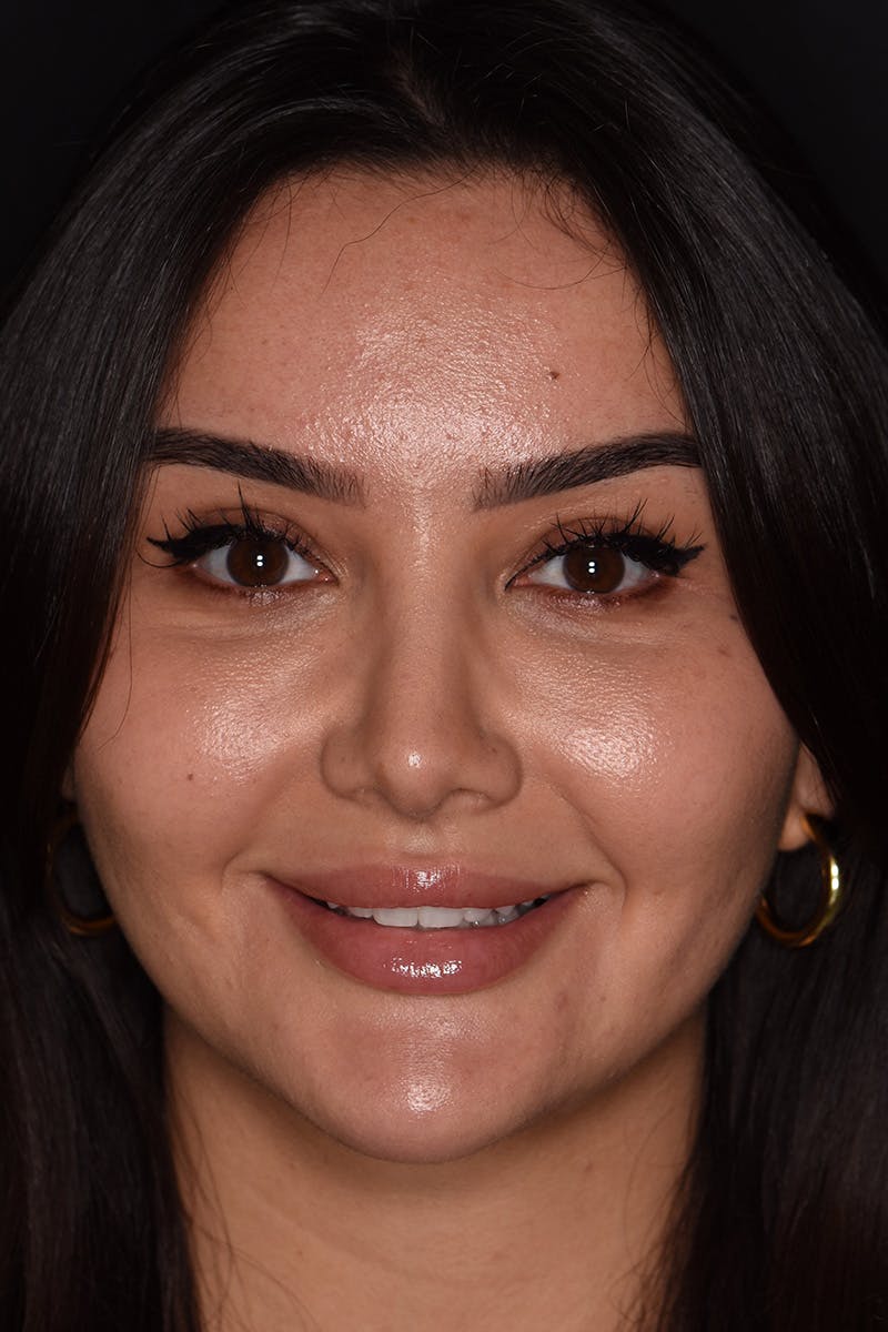 Patient Smile Before & After Gallery - Patient 117429 - Image 2