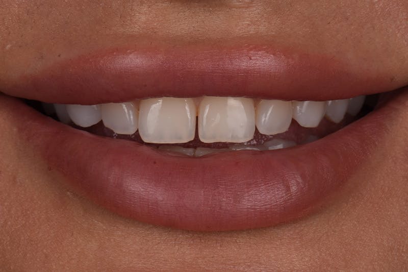 Patient Smile Before & After Gallery - Patient 117429 - Image 3