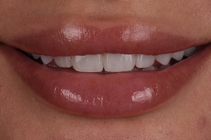 Patient Smile Before & After Gallery - Patient 117429 - Image 4