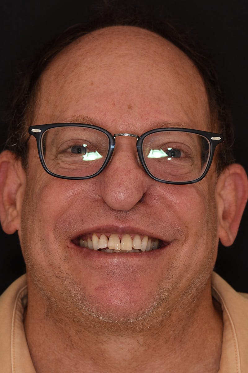 Patient Smile Before & After Gallery - Patient 165201 - Image 1