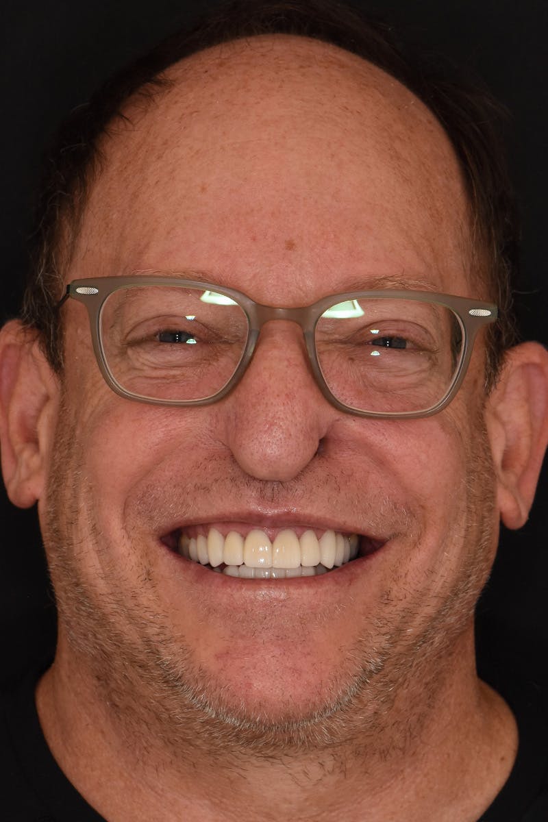 Patient Smile Before & After Gallery - Patient 165201 - Image 2