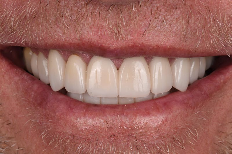 Patient Smile Before & After Gallery - Patient 165201 - Image 4