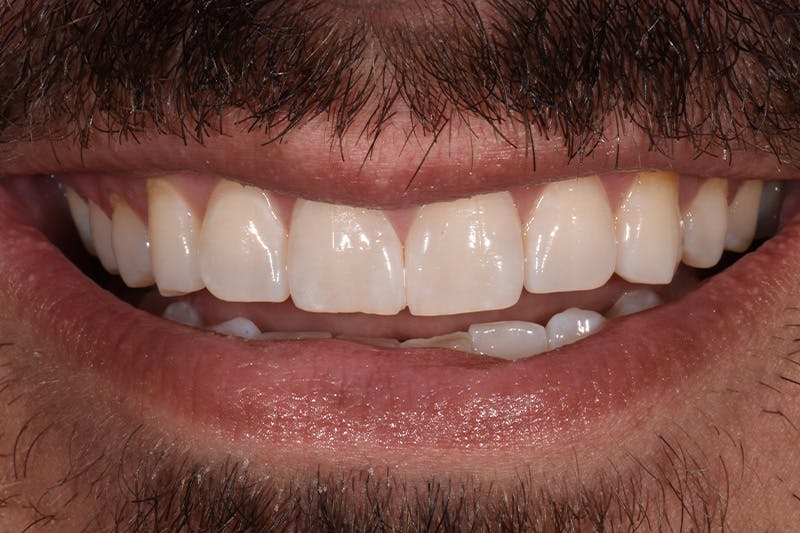 Patient Smile Before & After Gallery - Patient 694728 - Image 1
