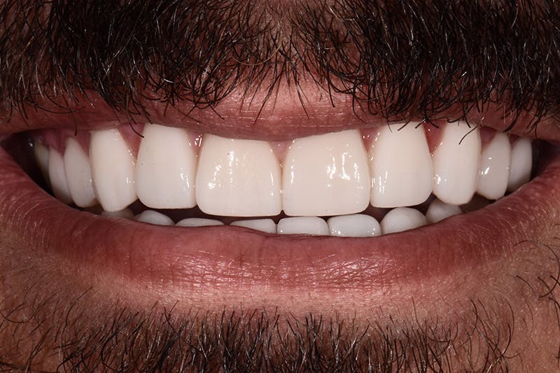 Patient Smile Before & After Gallery - Patient 694728 - Image 2