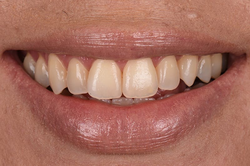 Patient Smile Before & After Gallery - Patient 167261 - Image 3