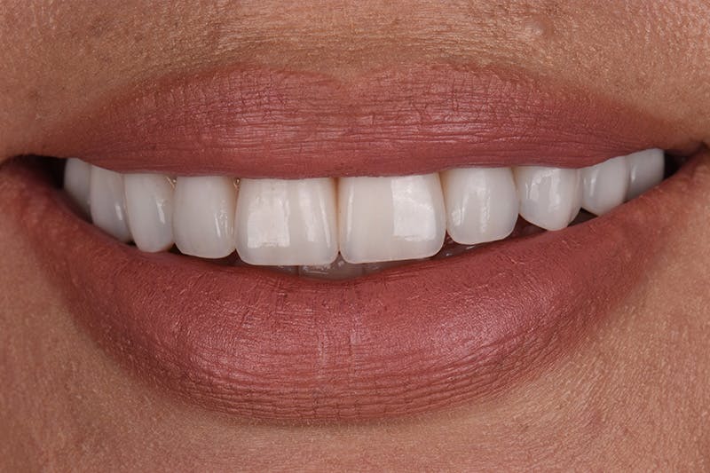 Patient Smile Before & After Gallery - Patient 167261 - Image 4