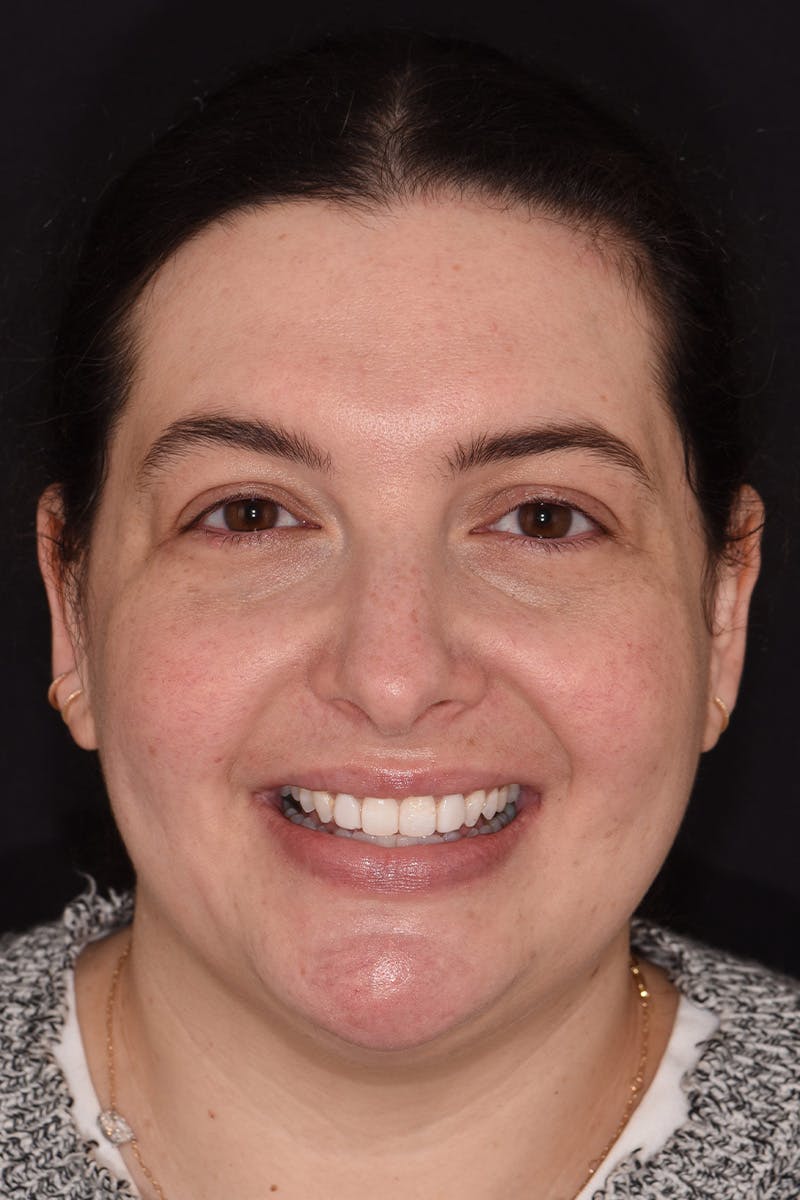 Patient Smile Before & After Gallery - Patient 158011 - Image 1
