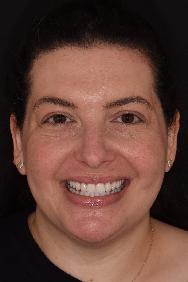 Patient Smile Before & After Gallery - Patient 158011 - Image 2