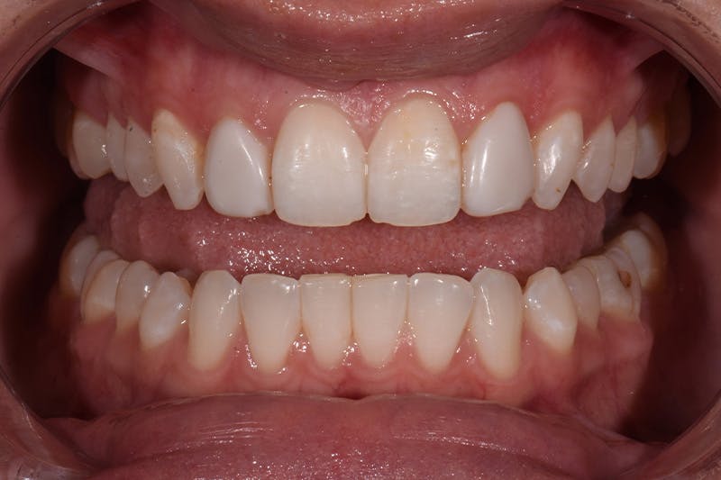 Patient Smile Before & After Gallery - Patient 158011 - Image 3
