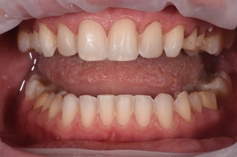 Patient Smile Before & After Gallery - Patient 158011 - Image 4