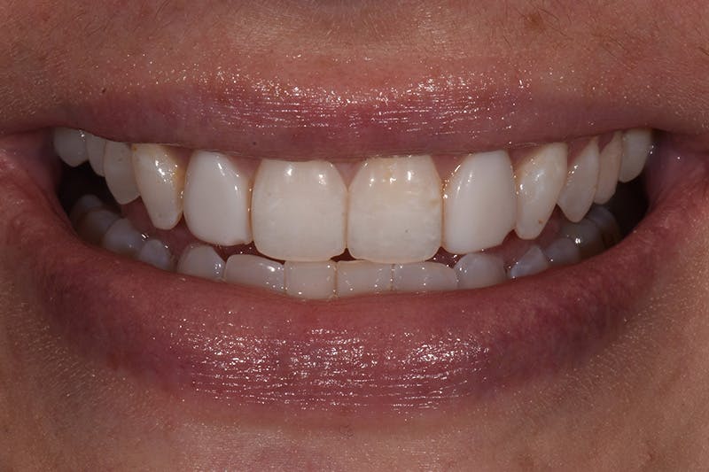 Patient Smile Before & After Gallery - Patient 158011 - Image 5