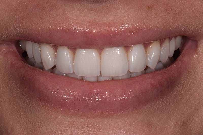 Patient Smile Before & After Gallery - Patient 158011 - Image 6