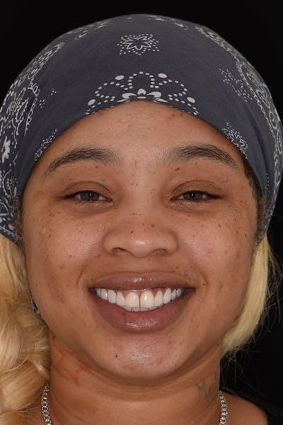 Patient Smile Before & After Gallery - Patient 114986 - Image 1