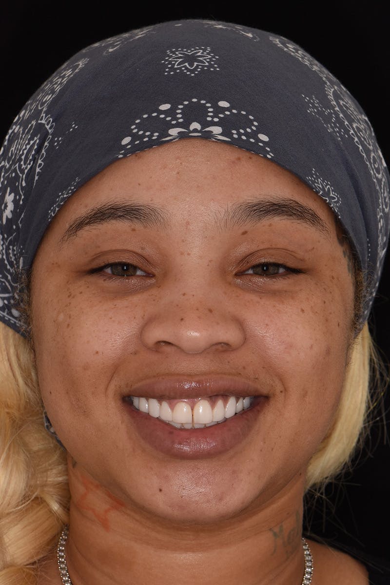 Patient Smile Before & After Gallery - Patient 114986 - Image 1