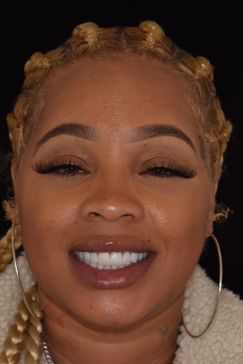 Patient Smile Before & After Gallery - Patient 114986 - Image 2