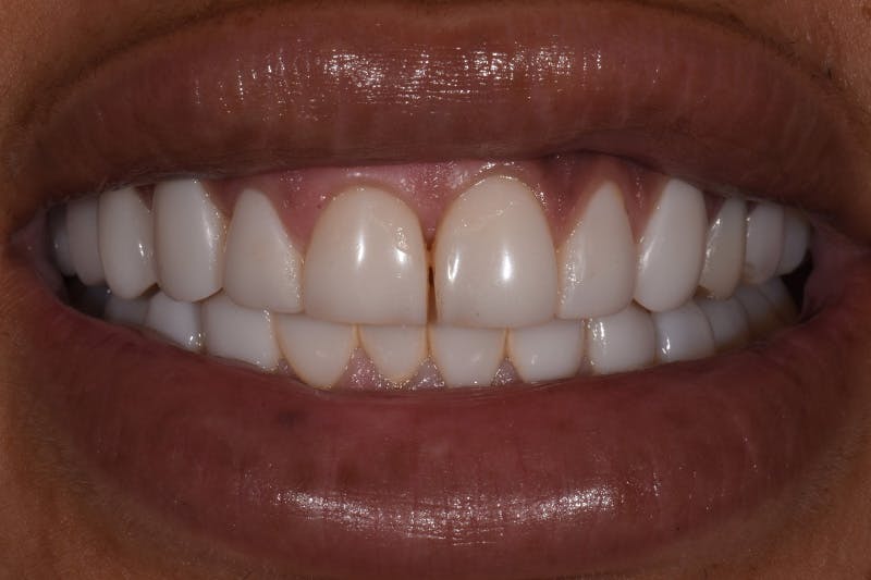 Patient Smile Before & After Gallery - Patient 114986 - Image 3