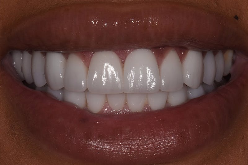 Patient Smile Before & After Gallery - Patient 114986 - Image 4