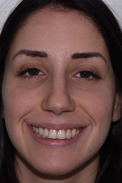 Patient Smile Before & After Gallery - Patient 377230 - Image 1