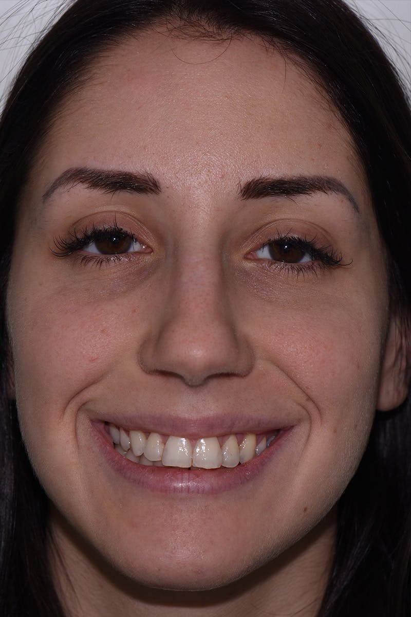 Patient Smile Before & After Gallery - Patient 377230 - Image 1
