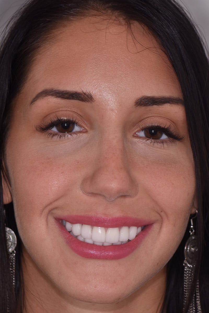 Patient Smile Before & After Gallery - Patient 377230 - Image 2