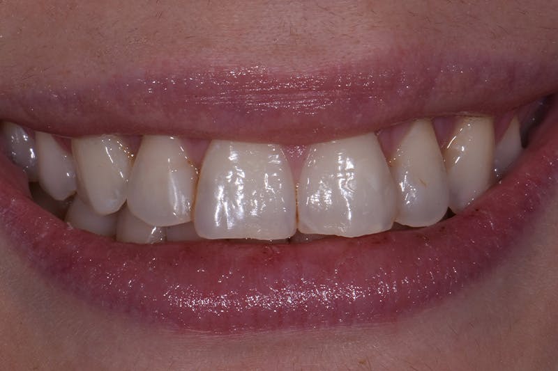 Patient Smile Before & After Gallery - Patient 377230 - Image 3