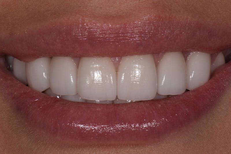 Patient Smile Before & After Gallery - Patient 377230 - Image 4